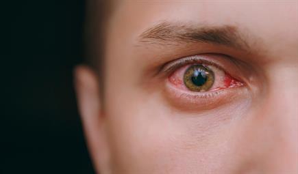 7 Reasons Why Your Eyes May Be Red