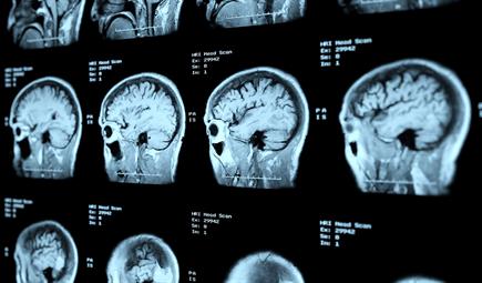 التعرف على السكتة الدماغية 