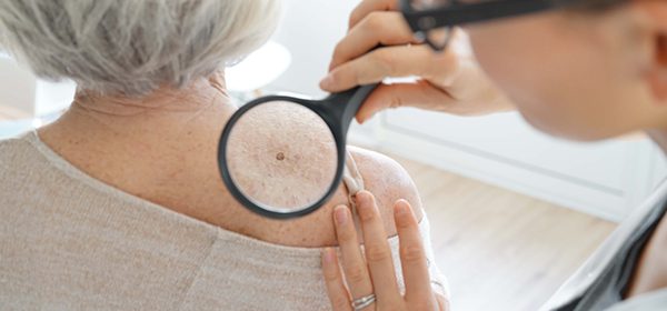 Skin Cancer
