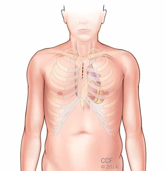 minimally invasive and robotically assisted heart surgery.png