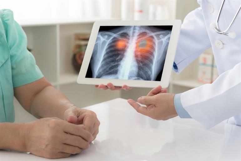 Lung Cancer Screening