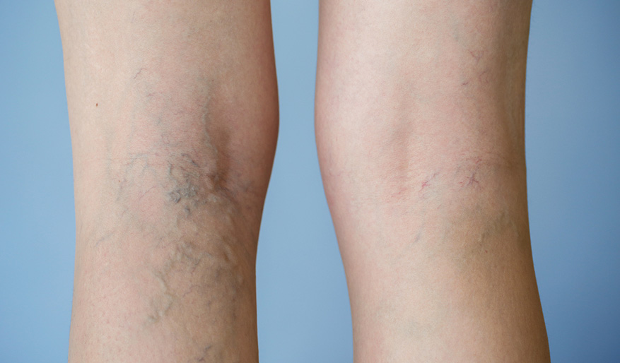 كيف يتم تشخيص مشكلة دوالي الساقين؟ Ccad-img-blog-varicose-veins-HL