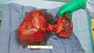 a massive cancerous tumor growing in the pancreas 