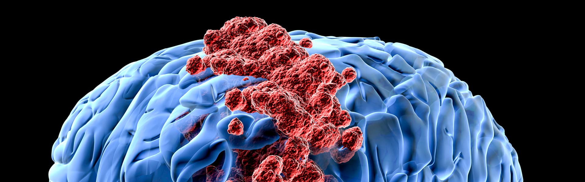 برنامج علاج أورام الدماغ والعمود الفقري