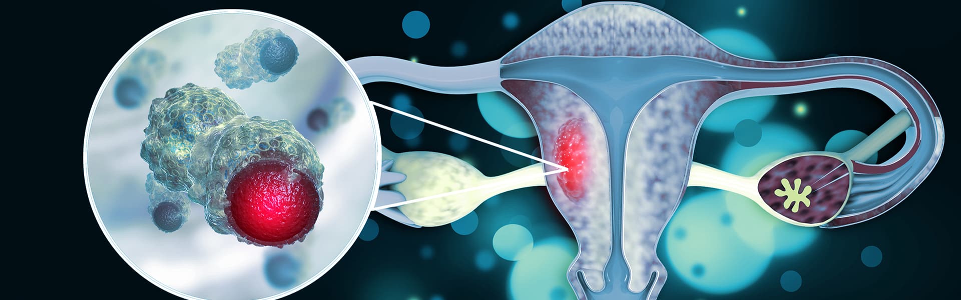 برنامج علاج سرطان عنق الرحم