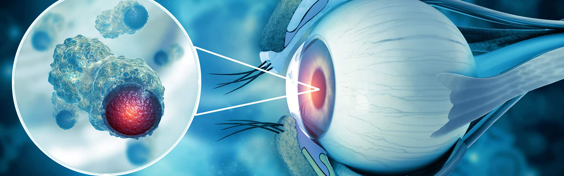 برنامج علاج أورام العين