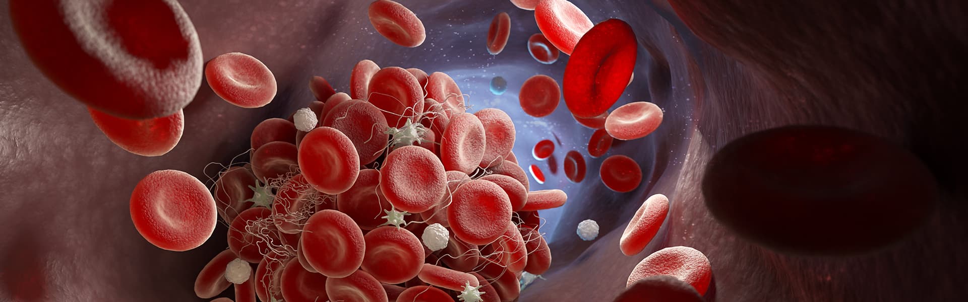 Leukemia