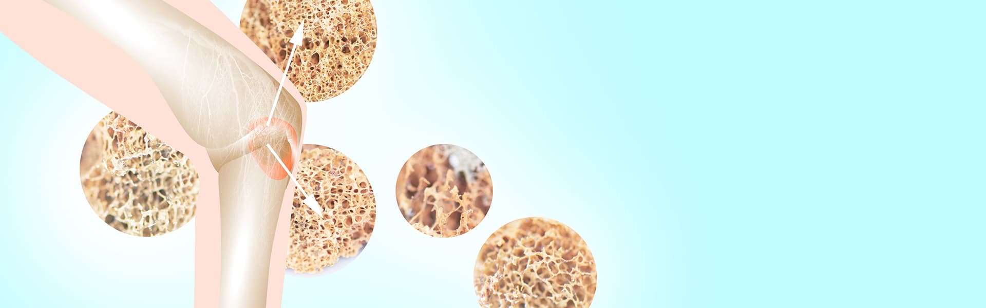 Myeloma
