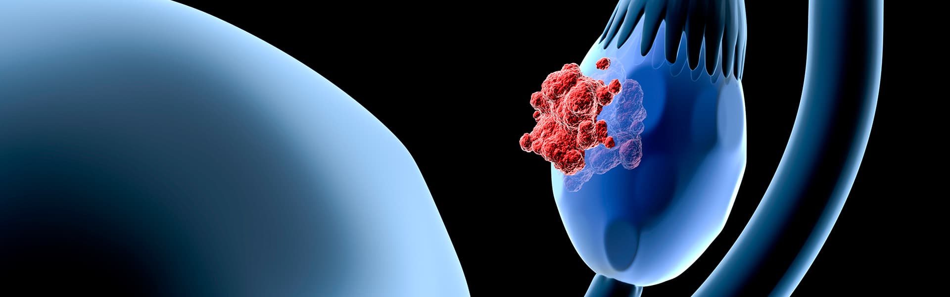 برنامج علاج سرطان بطانة الرحم