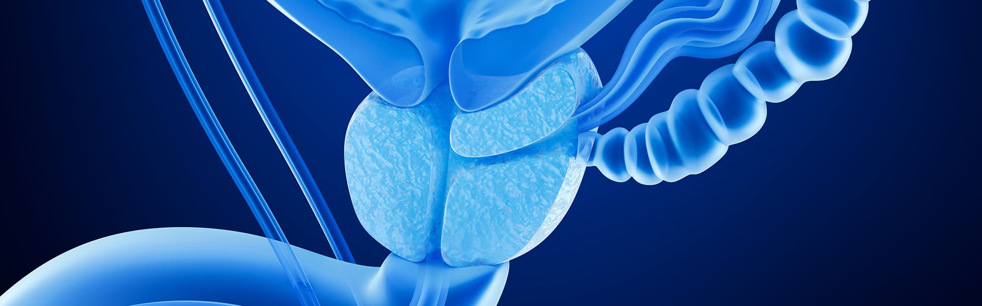 برنامج علاج سرطان البروستات