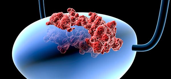 Bladder and Urothelial Cancer Program