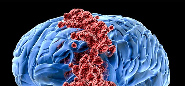 Brain and Spinal Cord Tumors Program