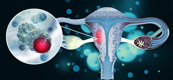 Cervical Cancer Program