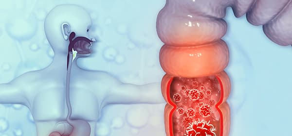 Colorectal-Cancer-Program