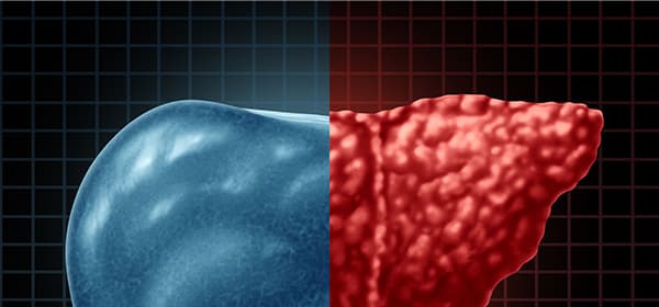 Liver Cancer Program