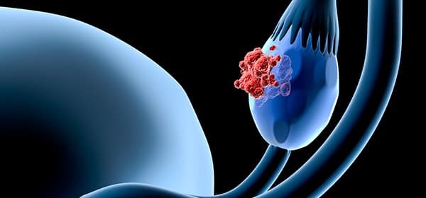 Cervical Cancer Program