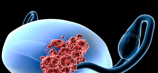 Uterine Cancer Program