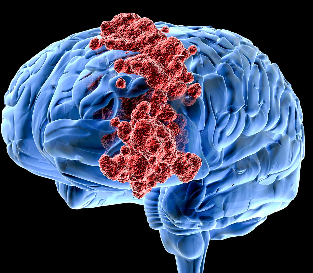 Brain and Spinal Cord Tumors Program