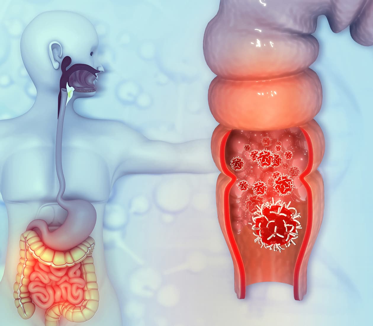 Colorectal-Cancer-Program