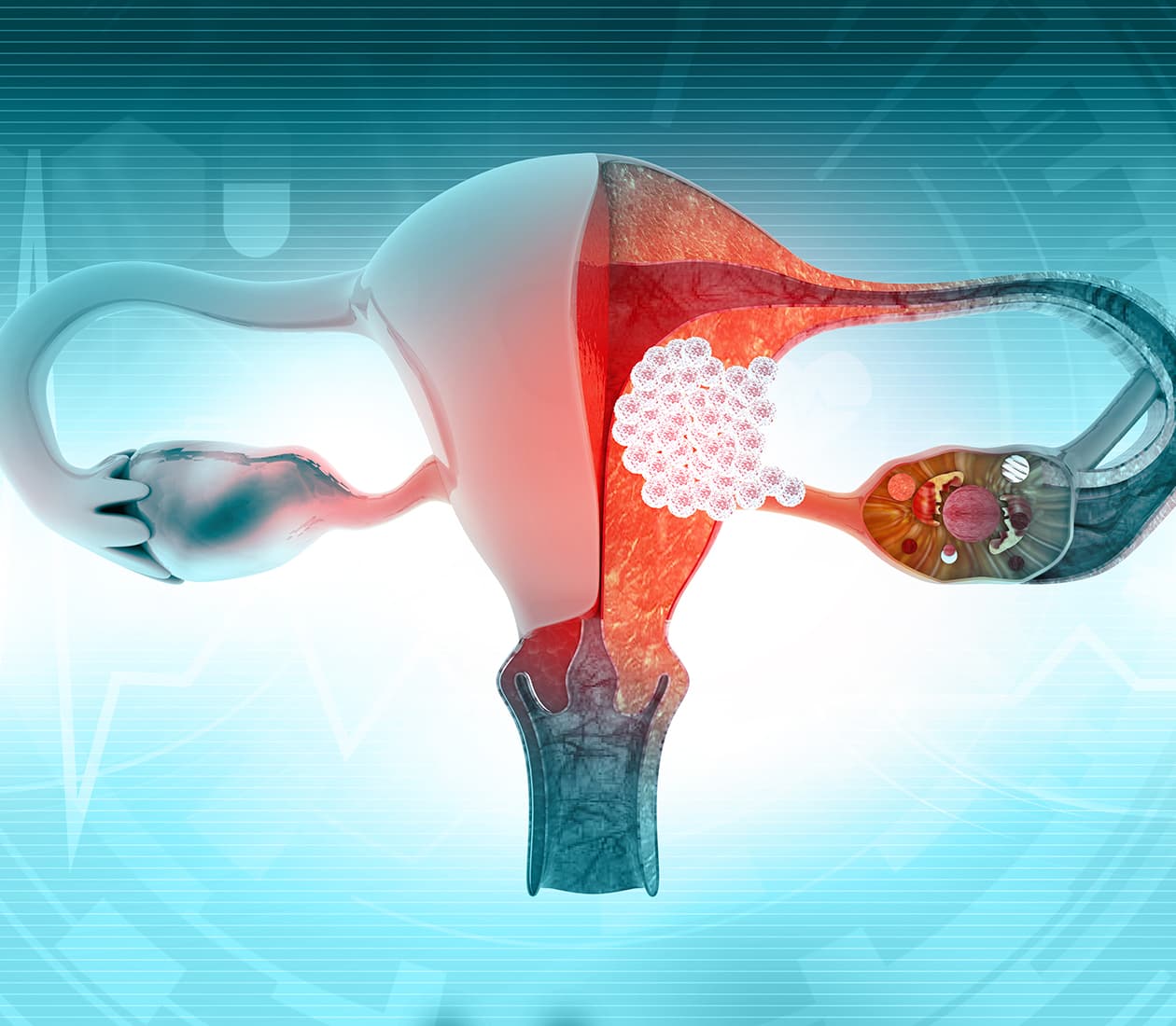 Gynecological Cancer