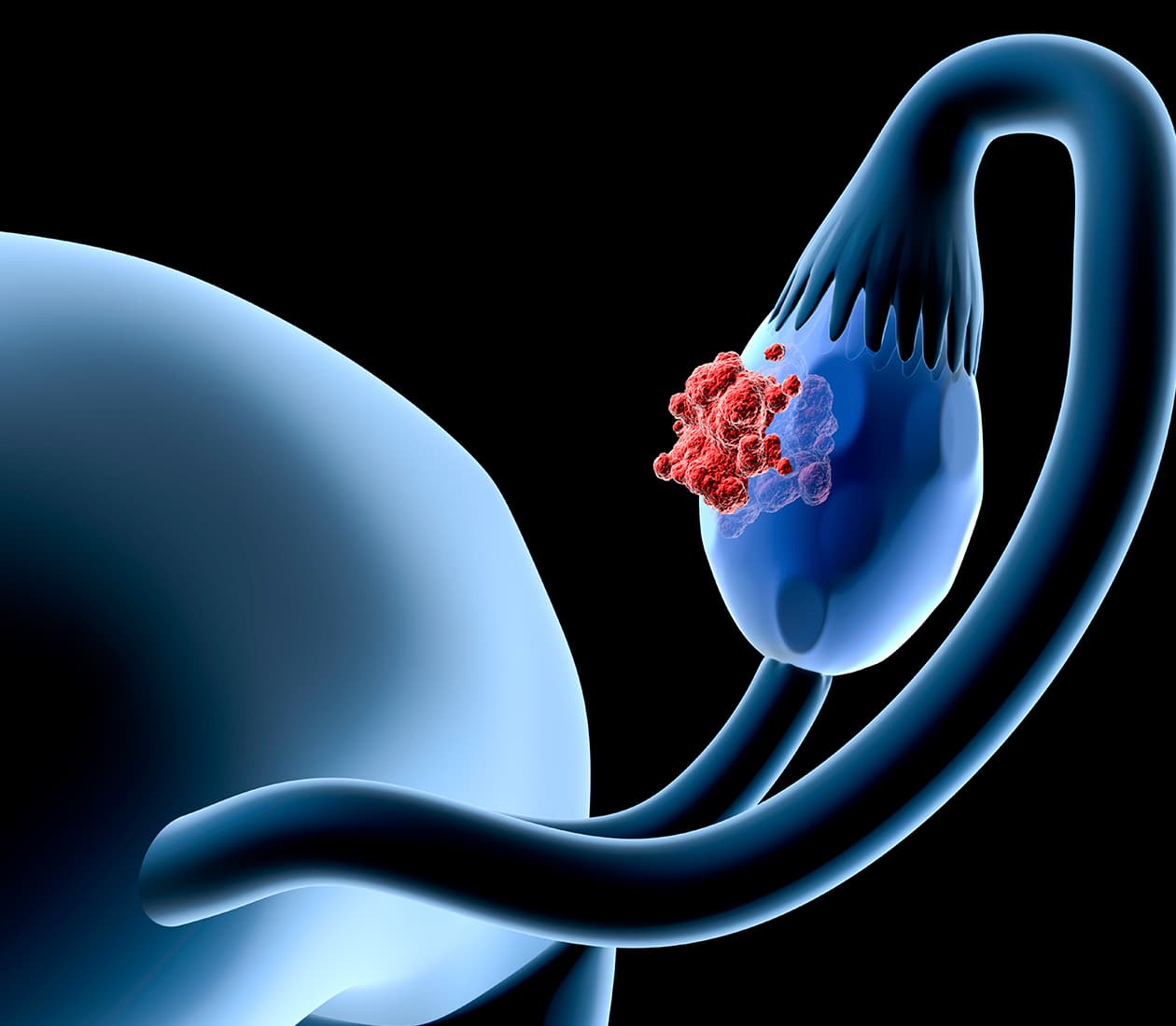 Ovarian Cancer Program