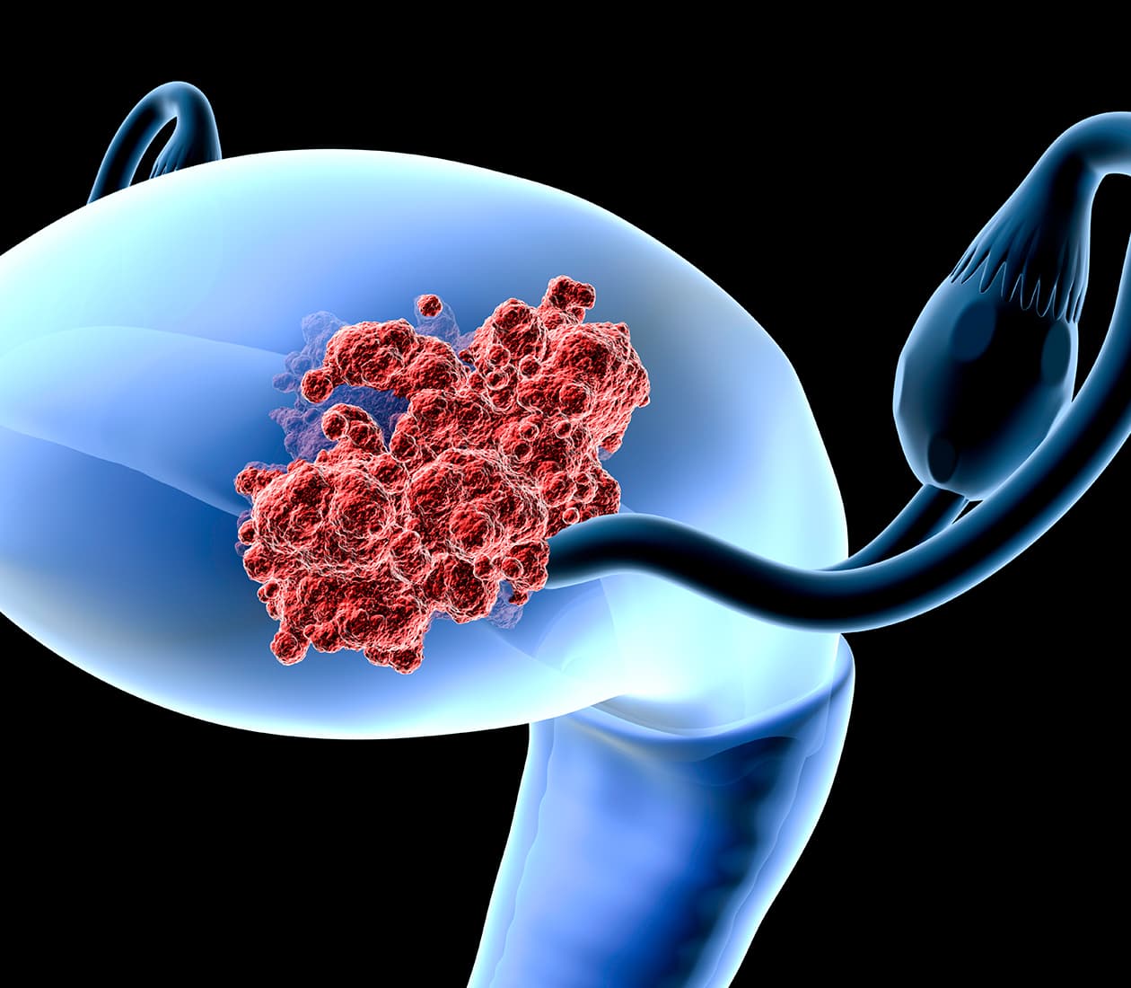 Uterine Cancer Program