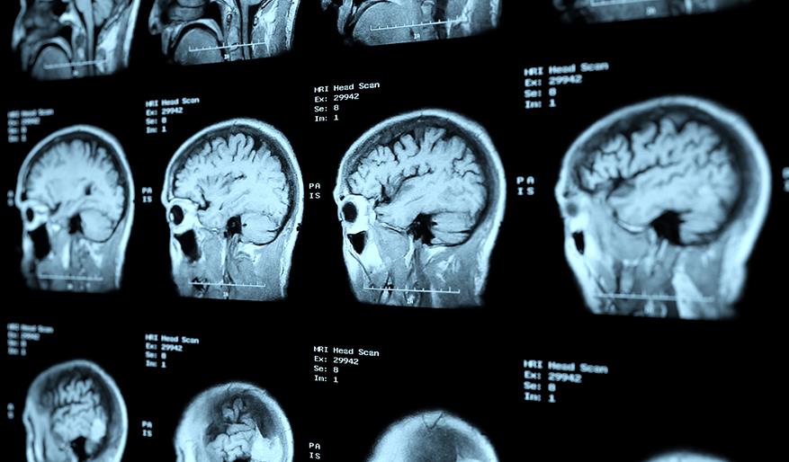image of stroke symptoms