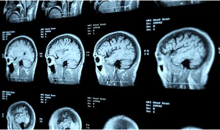 image of stroke symptoms