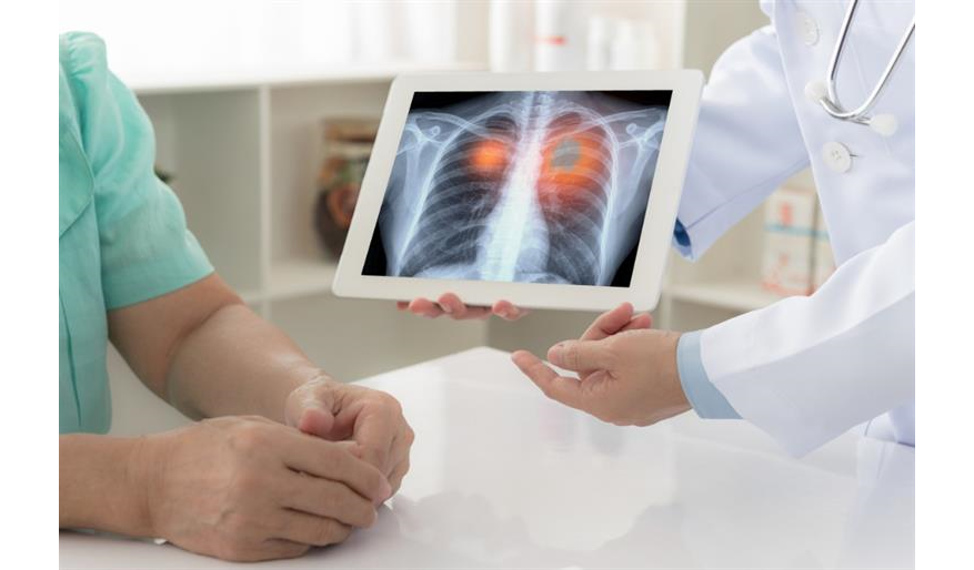 فحص الكشف عن سرطان الرئة