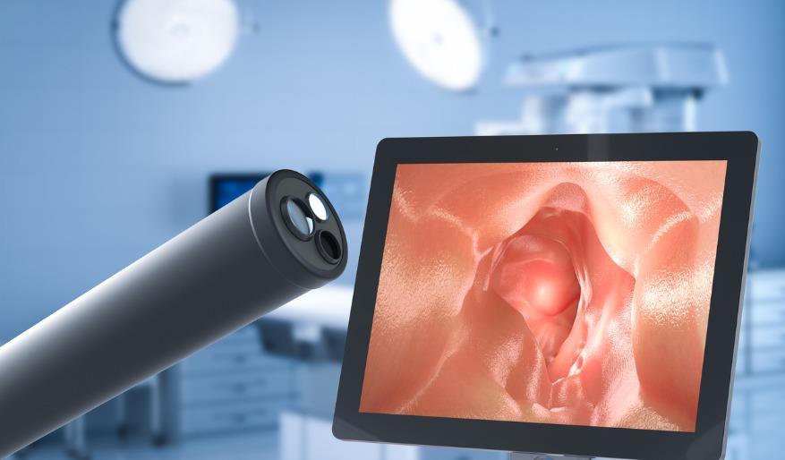 When Should I Get Screened for Colorectal Cancer?